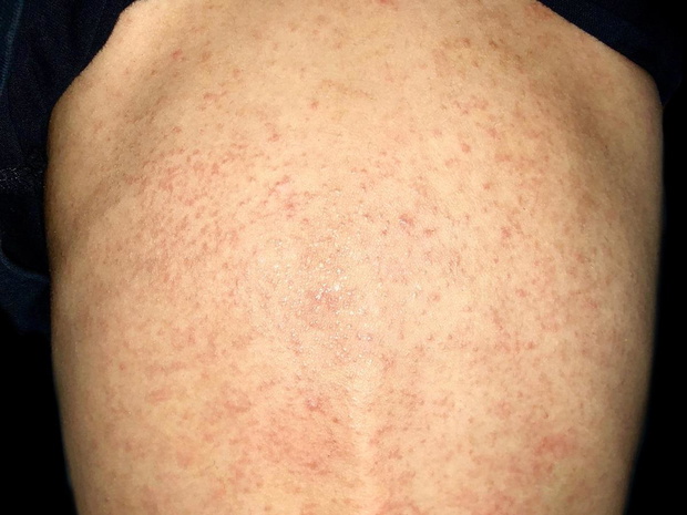hiv-objawy-skorne-zdjecia-2509843-a7a946b