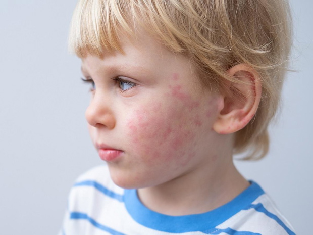 wysypka-alergiczna-u-dziecka-2493133-5a23dbc