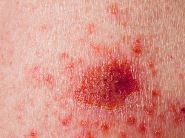 hiv-skora-wysypka-2509846-69cdfb6
