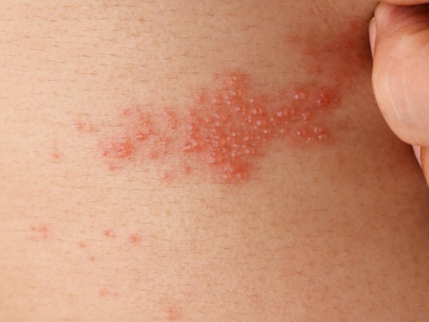 hiv-zdjecia-wysypka-2509845-4f14f16