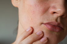 Retinol na przebarwienia