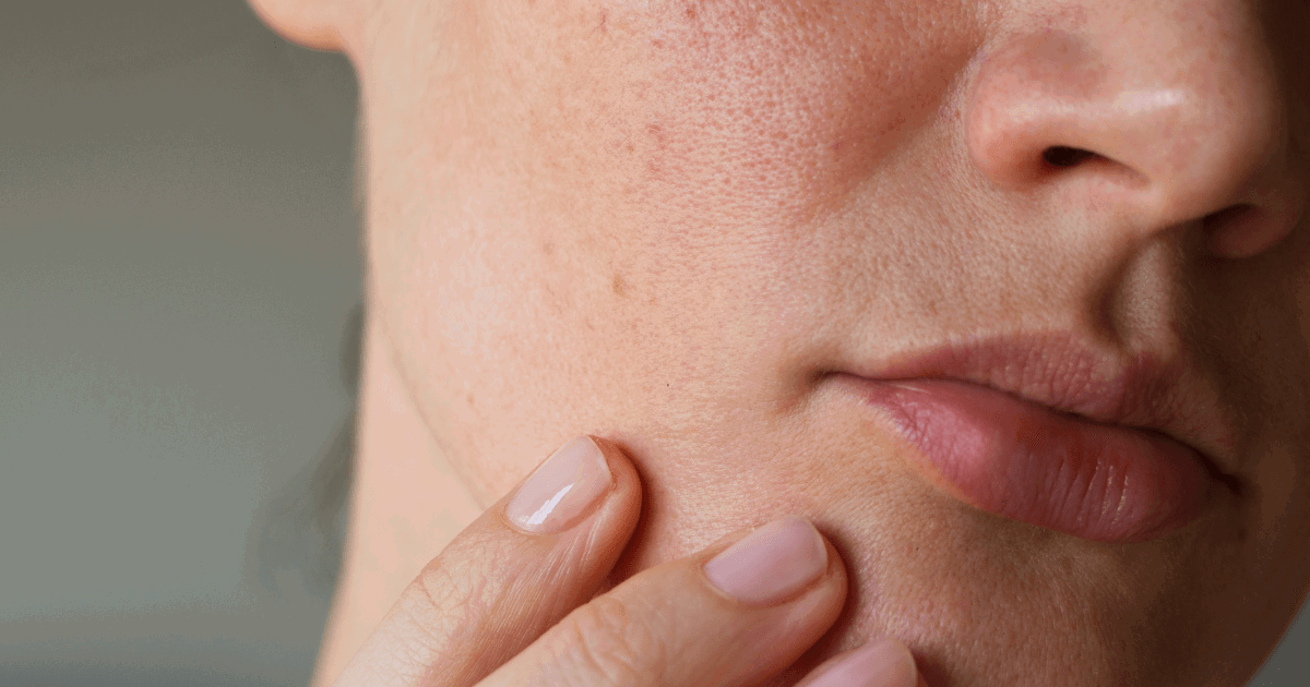 Retinol-na-przebarwienia-4c4f141.png?resize=1200%2C630