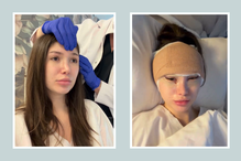 Młoda influencerka przeszła lifting skroniowy
