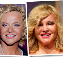 Joanna Kurowska, metamorfoza Joanny Kurowskiej, zabiegi medycyny estetycznej Joanny Kurowskiej