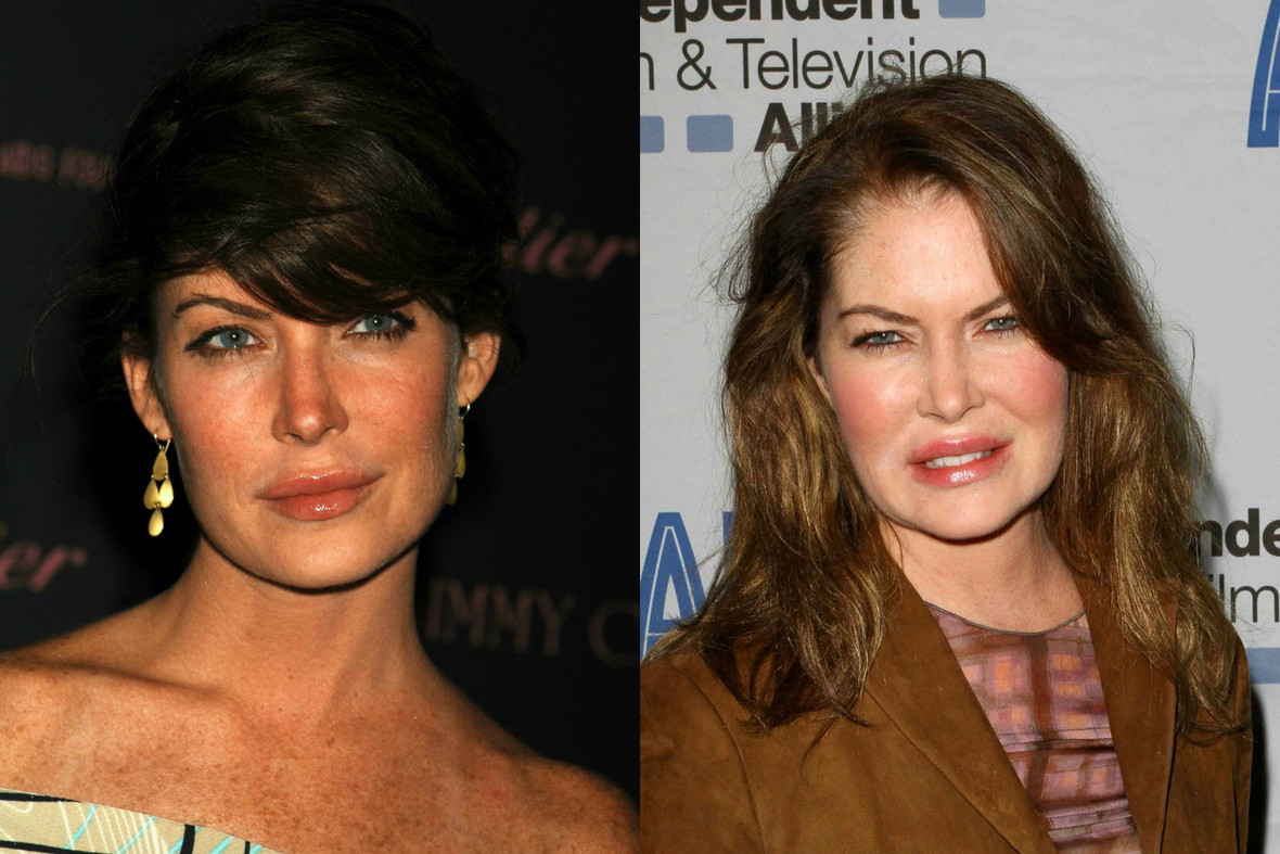 Lara Flynn Boyle, ofiary botoksu