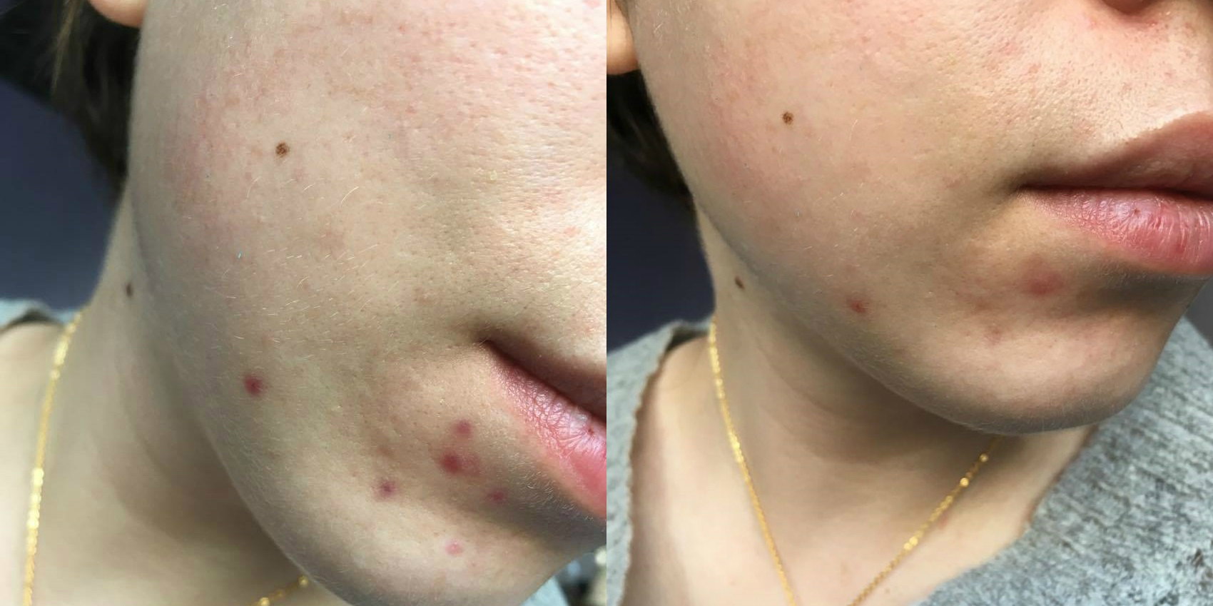 Zdjęcia z testowania żelu MediqSkin Plus, efekt przed i po