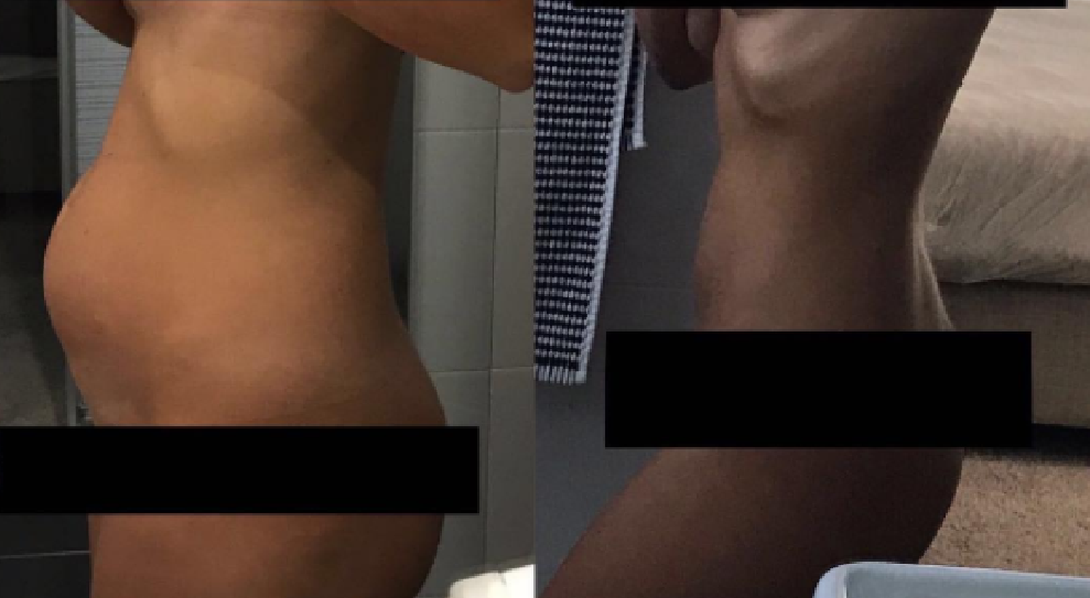 brzuch blogerki chorującej na endometriozę