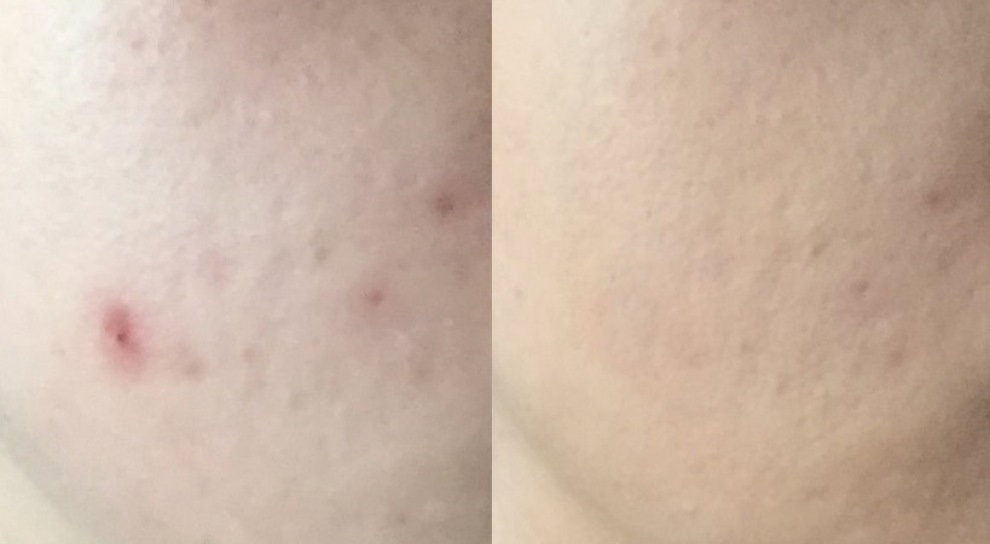 twarz przed i po zastosowaniu podkładu w kompakcie Avene