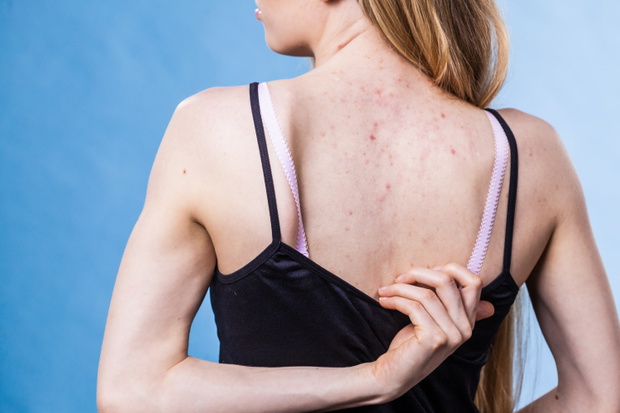 Woman with skin problem acne on back