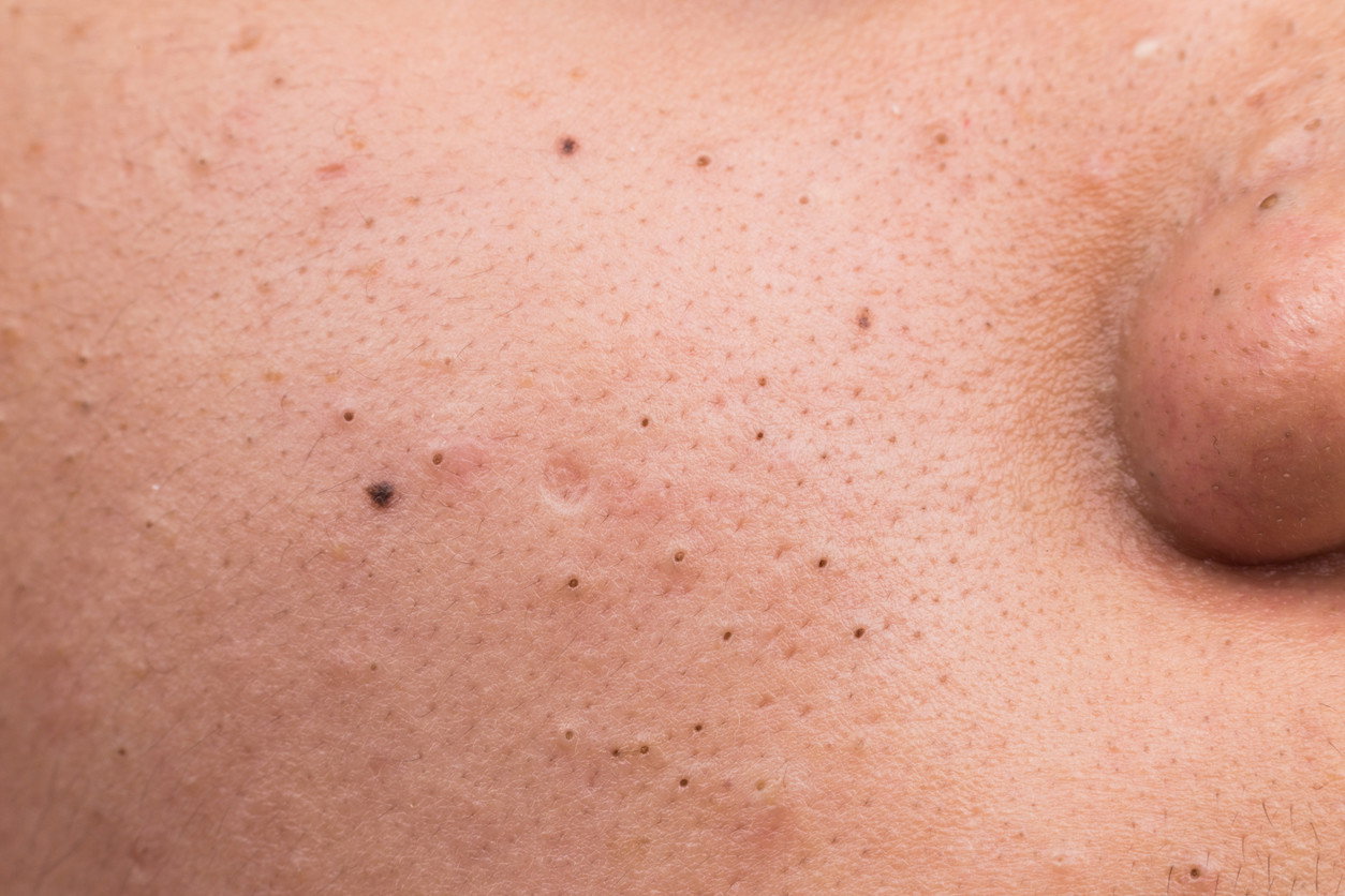 peeling kawitacyjny na zaskórniki