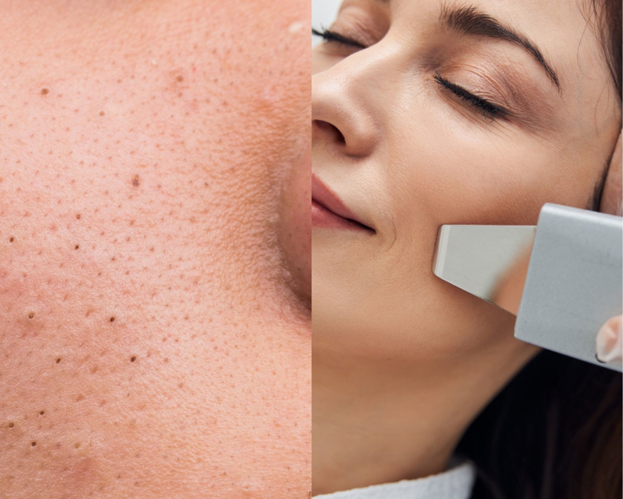 peeling kawitacyjny efekty na zaskórniki