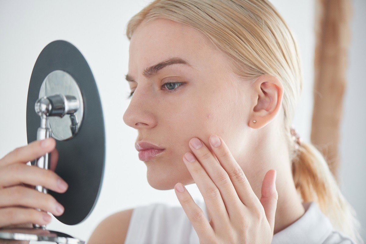 tolpa acne