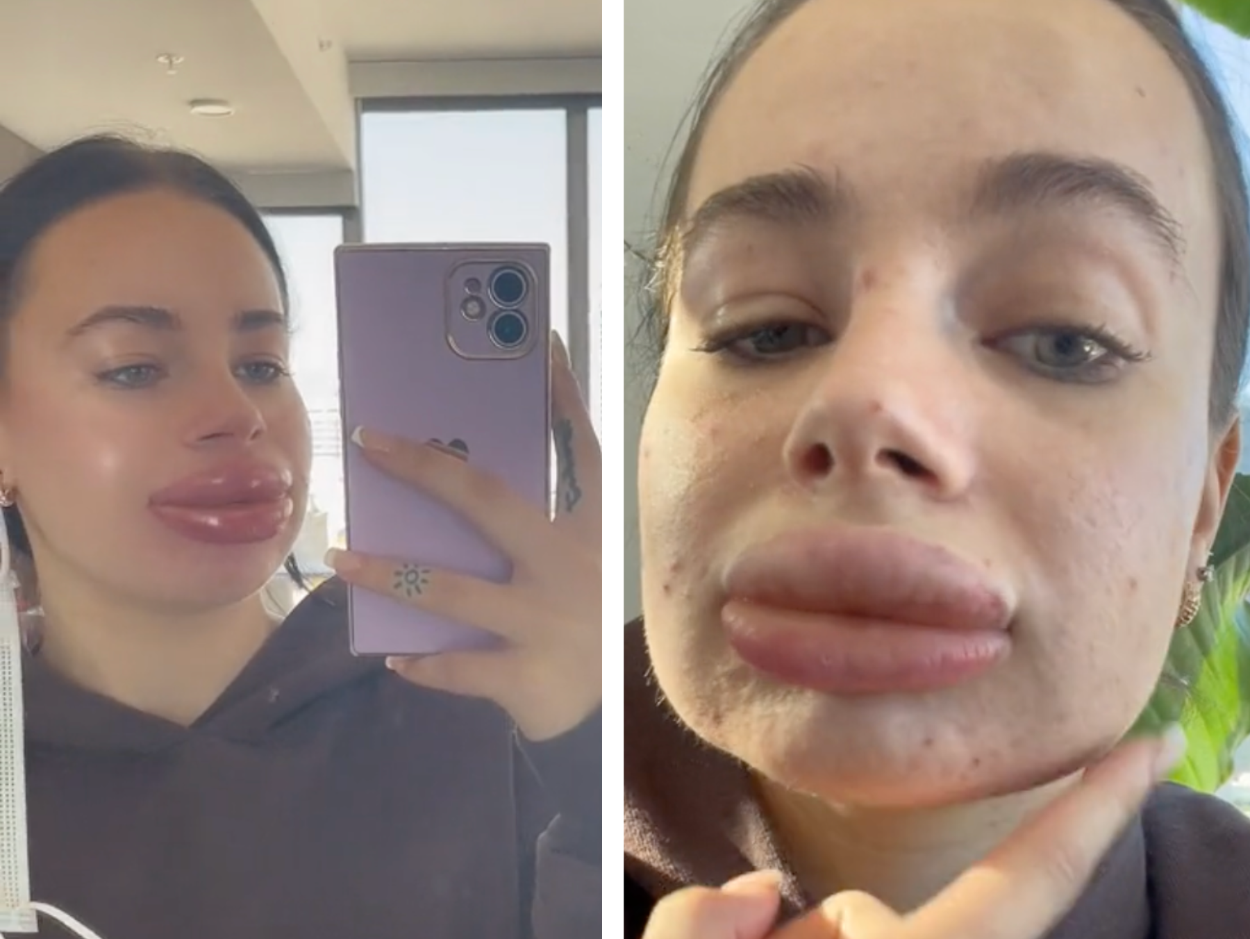 powikłania Influencerki po powiększaniu ust kwasem