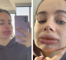 powikłania Influencerki po powiększaniu ust kwasem