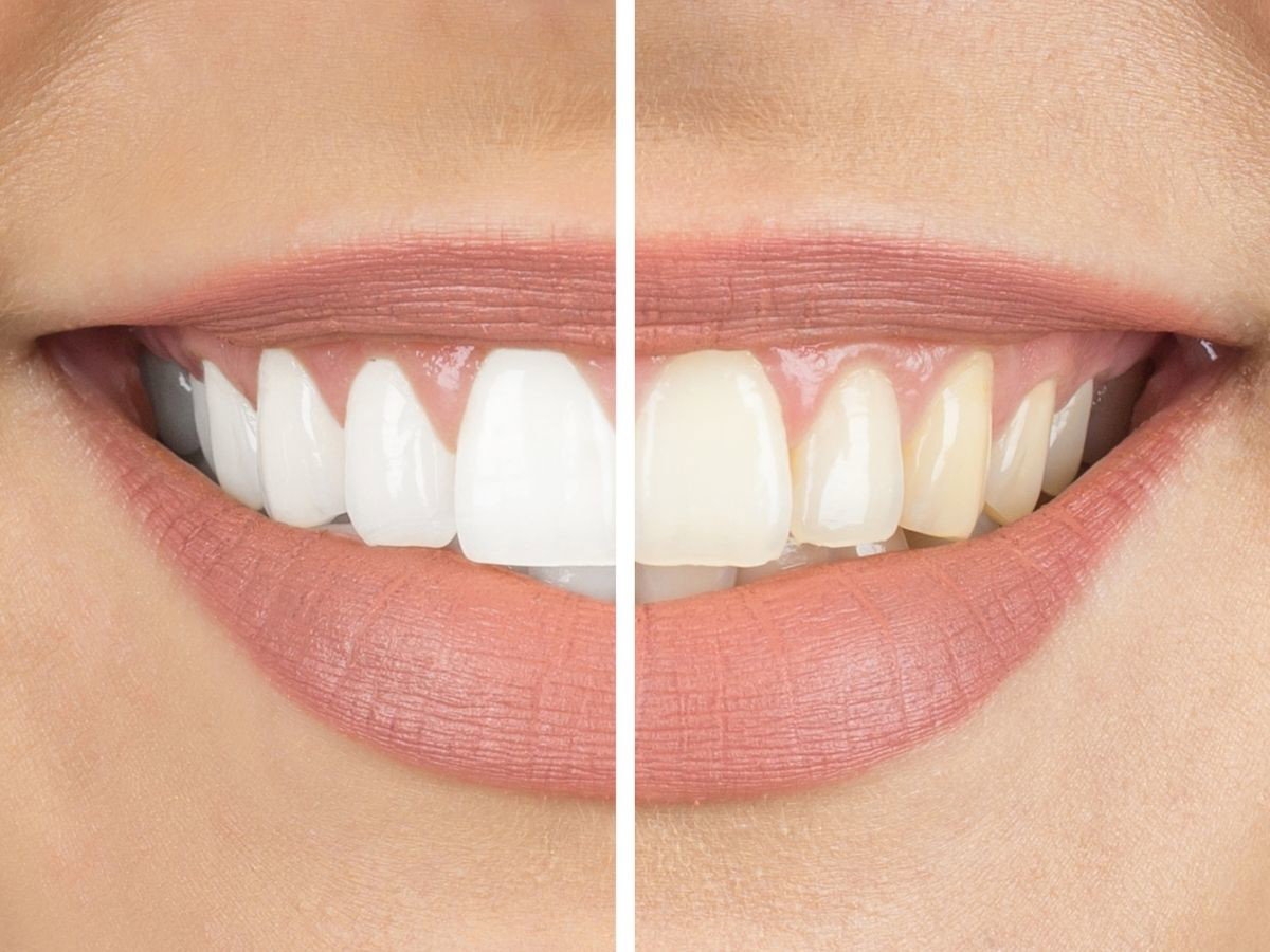 Wydaj 50 zł na ten proszek wybielający zamiast 800 zł u dentysty! „Po 2 użyciu jest zauważalna różnica”