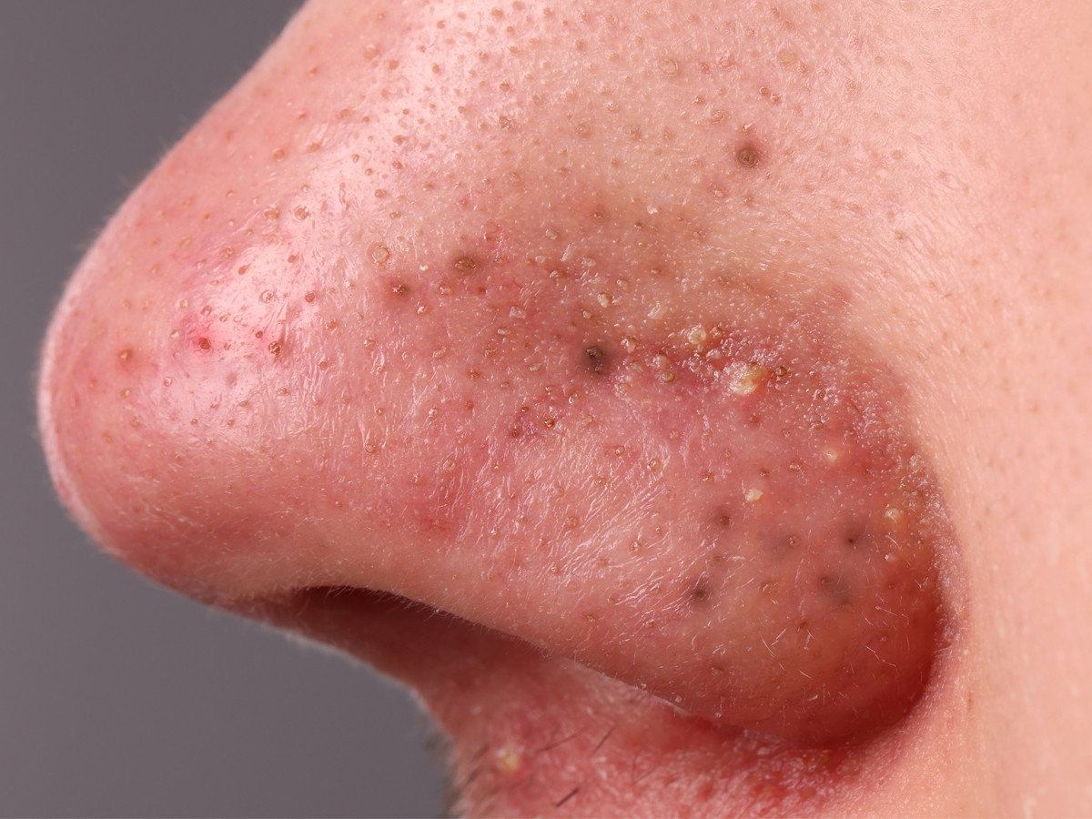 Włoski krem BB z morskimi ekstraktami to "blackheads killer". Zakrywa zaskórniki w 180 sekund, lepiej niż koreańskie kosmetyki