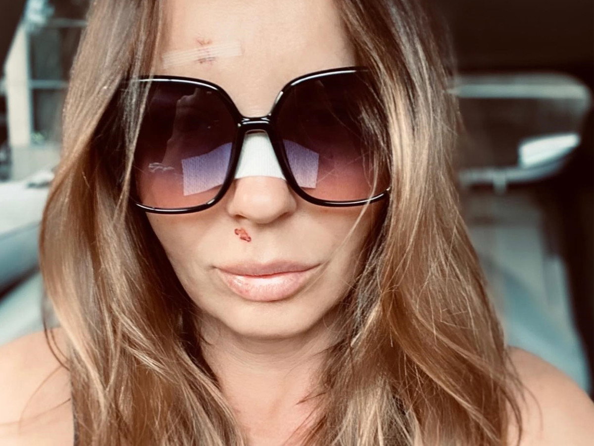 Agnieszka Włodarczyk przeszła operację nosa
