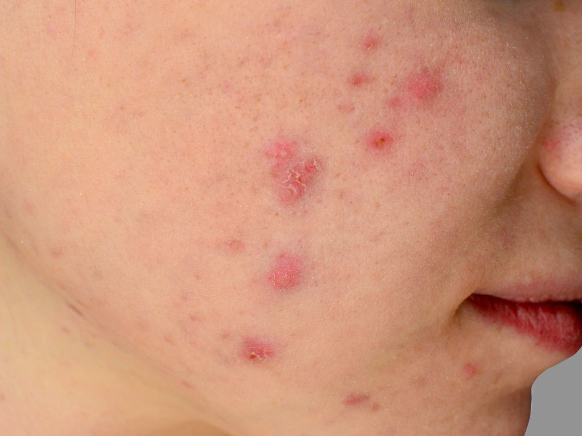 jak stosować retinol na trądzik