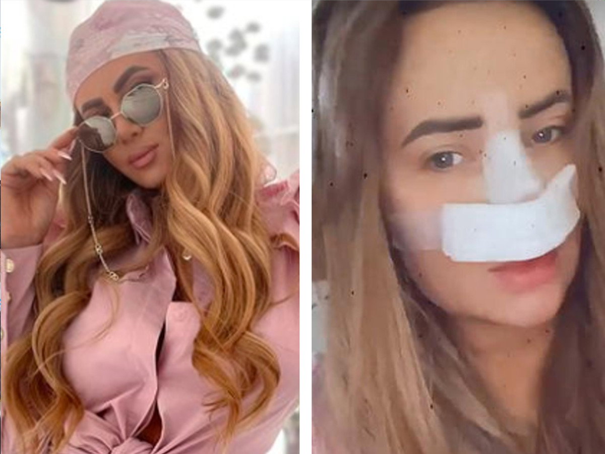 Królowe życia: Izabela Macudzińska o drugiej operacji nosa. - Nos zaczął mi się zapadać