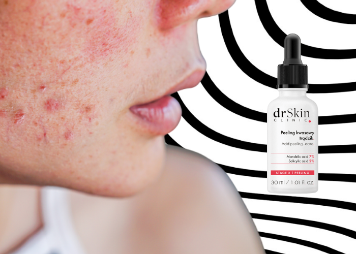 peeling kwasowy na trądzik od dr Skin