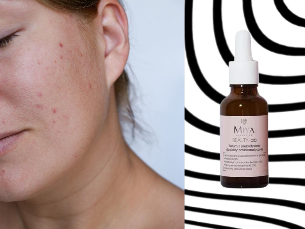przeciwtrądzikowe serum z prebiotykami