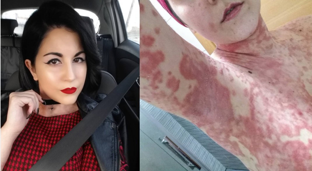 Selfie i ciało dziewczyny z łuszczycą
