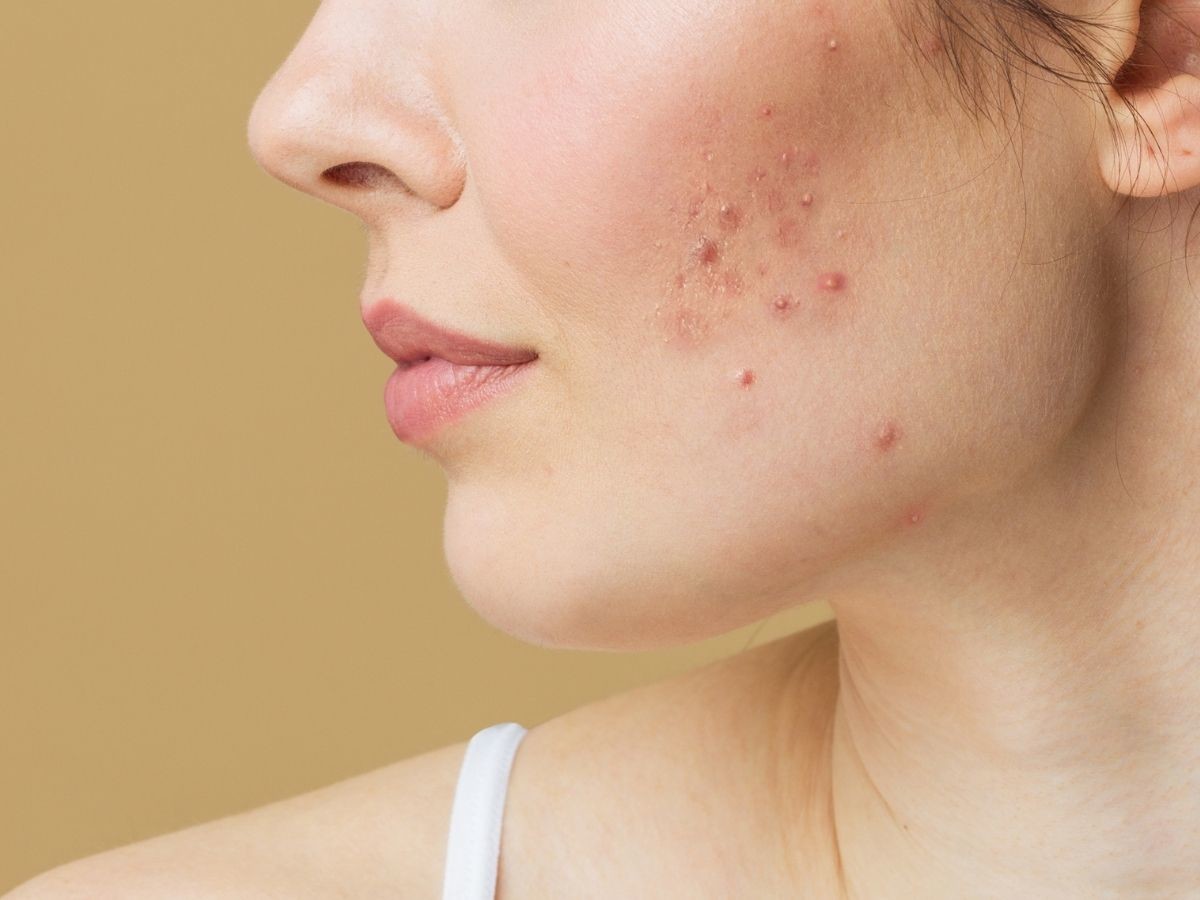 To nocne serum z kwasem glikolowym likwiduje trądzik i zaskórniki! „Mam węższe pory, a kaszka zniknęła”