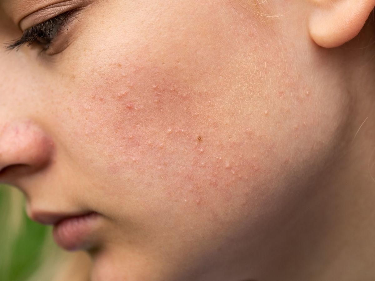 Ten kultowy peeling dziś kupimy 40% taniej! Zaskórniki znikają już po pierwszym użyciu