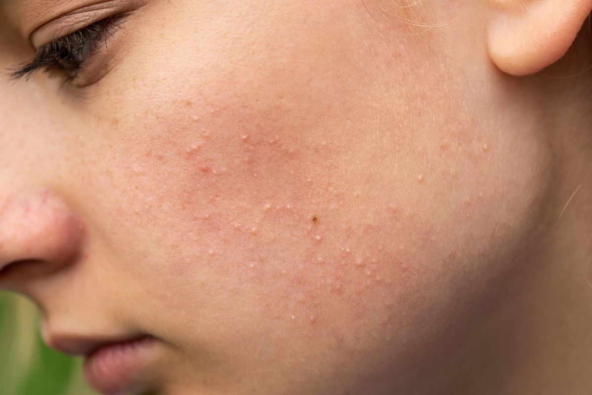 Ten kultowy peeling dziś kupimy 40% taniej! Zaskórniki znikają już po pierwszym użyciu