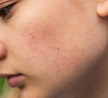 Ten kultowy peeling dziś kupimy 40% taniej! Zaskórniki znikają już po pierwszym użyciu