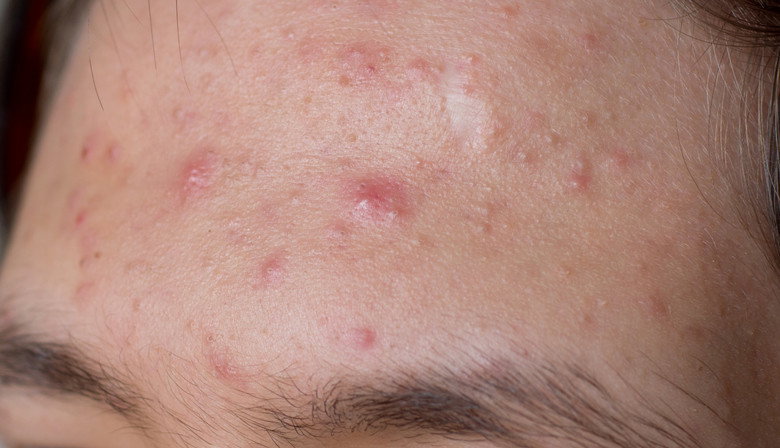 trądzik na twarzy przed zastosowaniem serum Nacomi