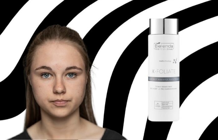 Dziewczyna z problemami skórnymi i produkt Bielenda Professional X-Foliate 