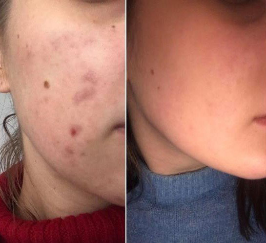 Efekty stosowania kremu Avene Cleanance Comedomed