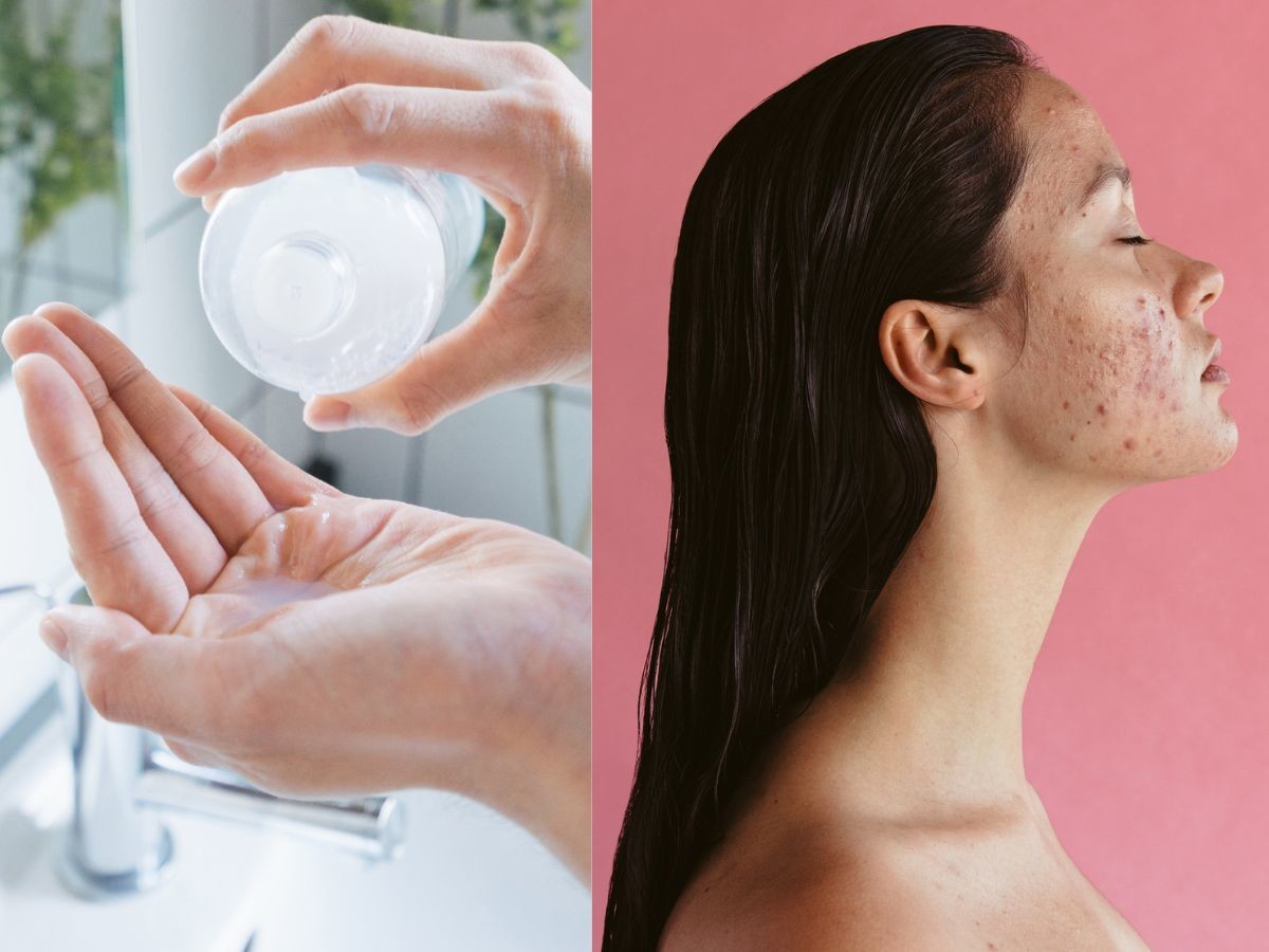 Dermatologiczna emulsja za 15 zł z koalinem zmniejsza trądzik i zaskórniki w tydzień