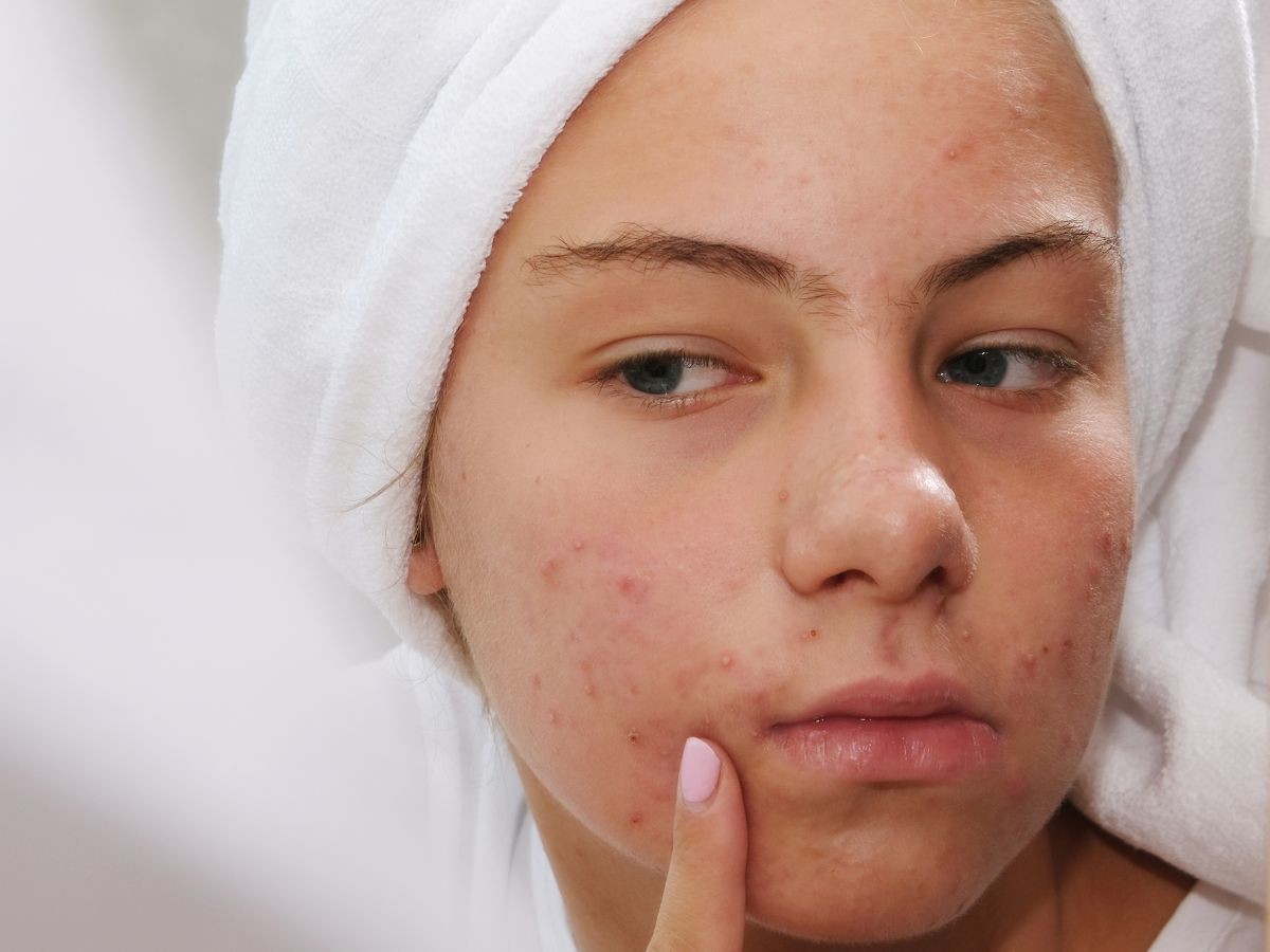 To serum z kwasem salicylowym kosztuje GROSZE , a działa jak odkurzacz do wągrów! „Już na drugi dzień krostki są przygaszone”
