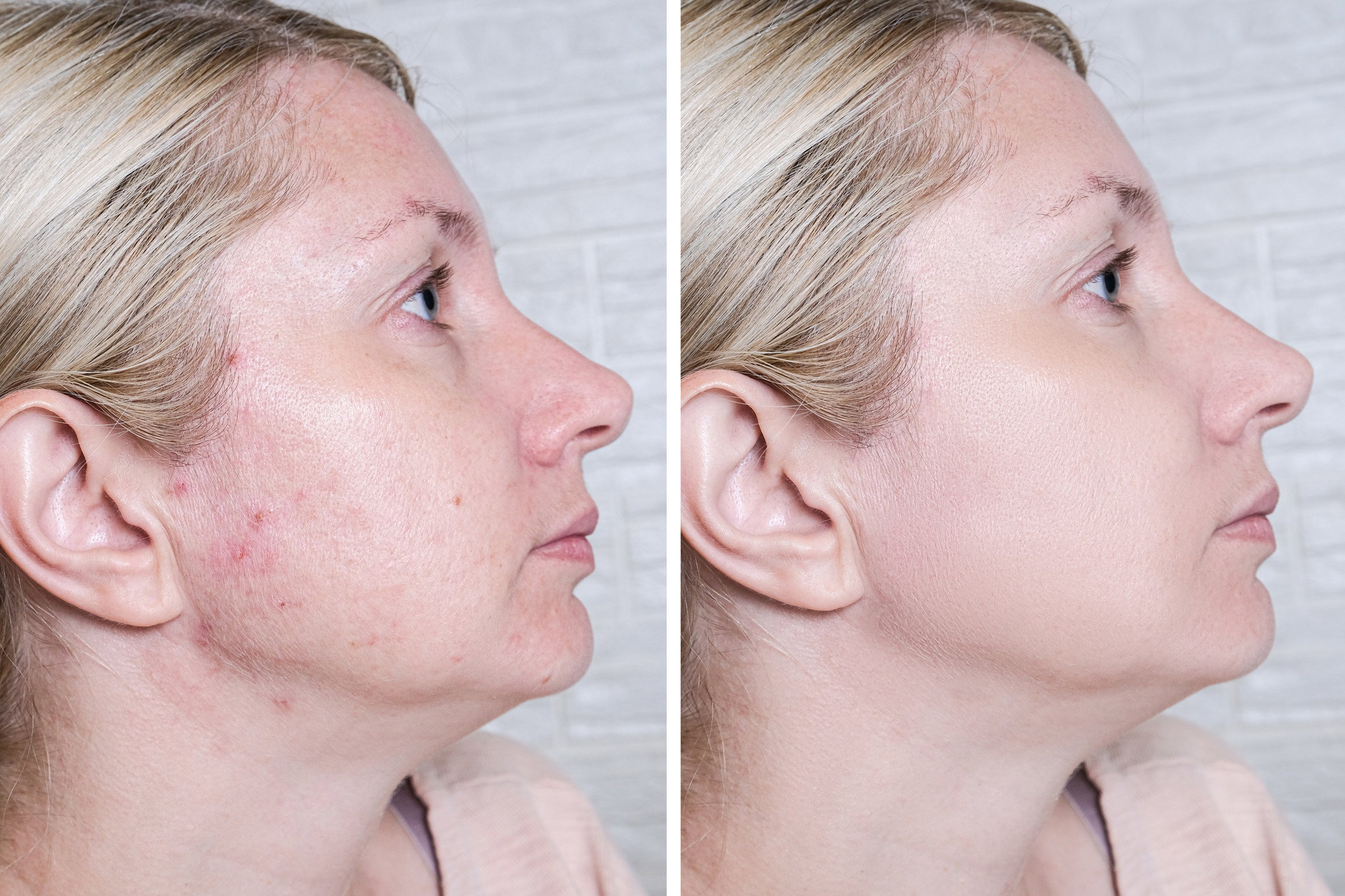 Acne Derm efekty na trądzik i przebarwienia