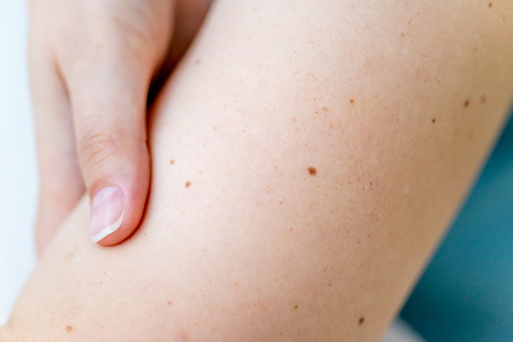 Wyzwanie Wrist Freckle Challenge. Ty też masz tutaj pieprzyk!