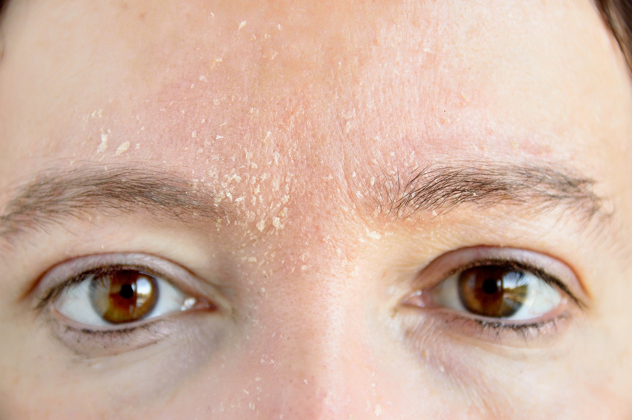sucha skóra twarzy