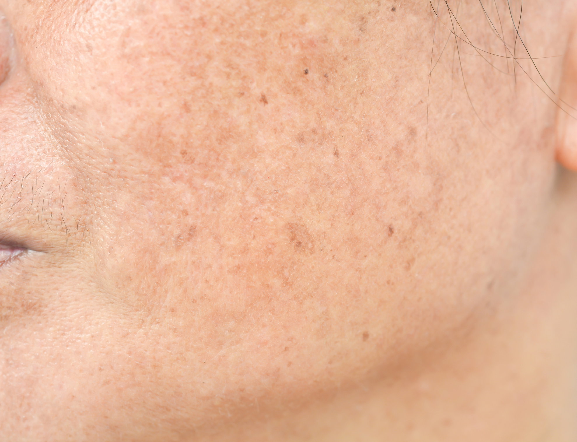 melasma