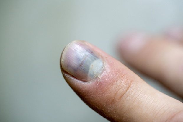 Bruised finger nail stock photo