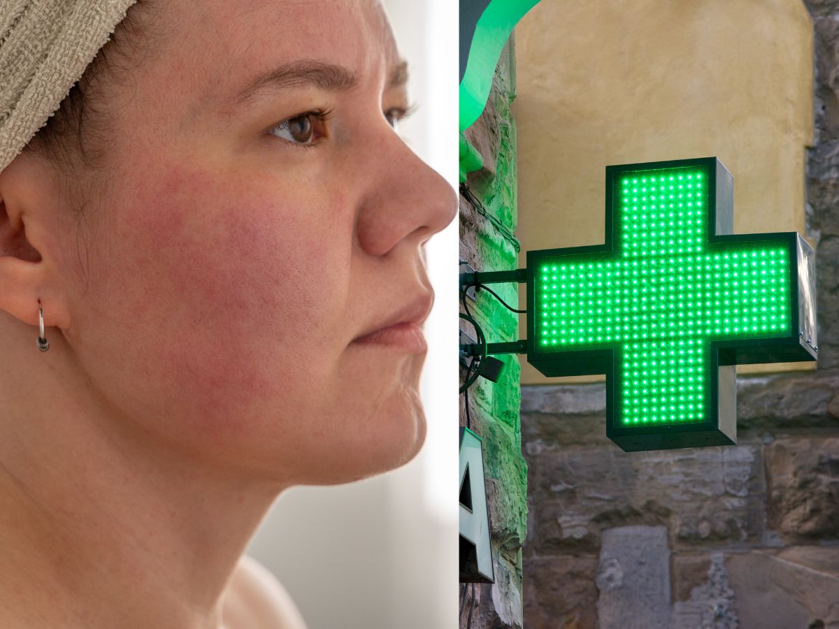 Krem z kwasem azelainowym na przebarwienia: acne derm krem