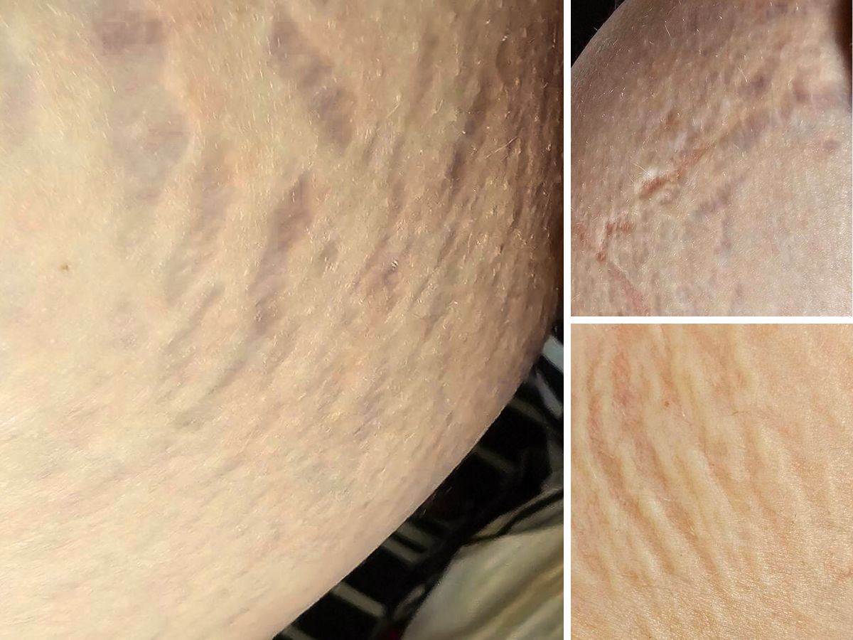 Mam 40 lat, a to moje TOP 5 kremów na cellulit i rozstępy. Wygładzają tzw. kalafiory i pomarańczowa skórkę