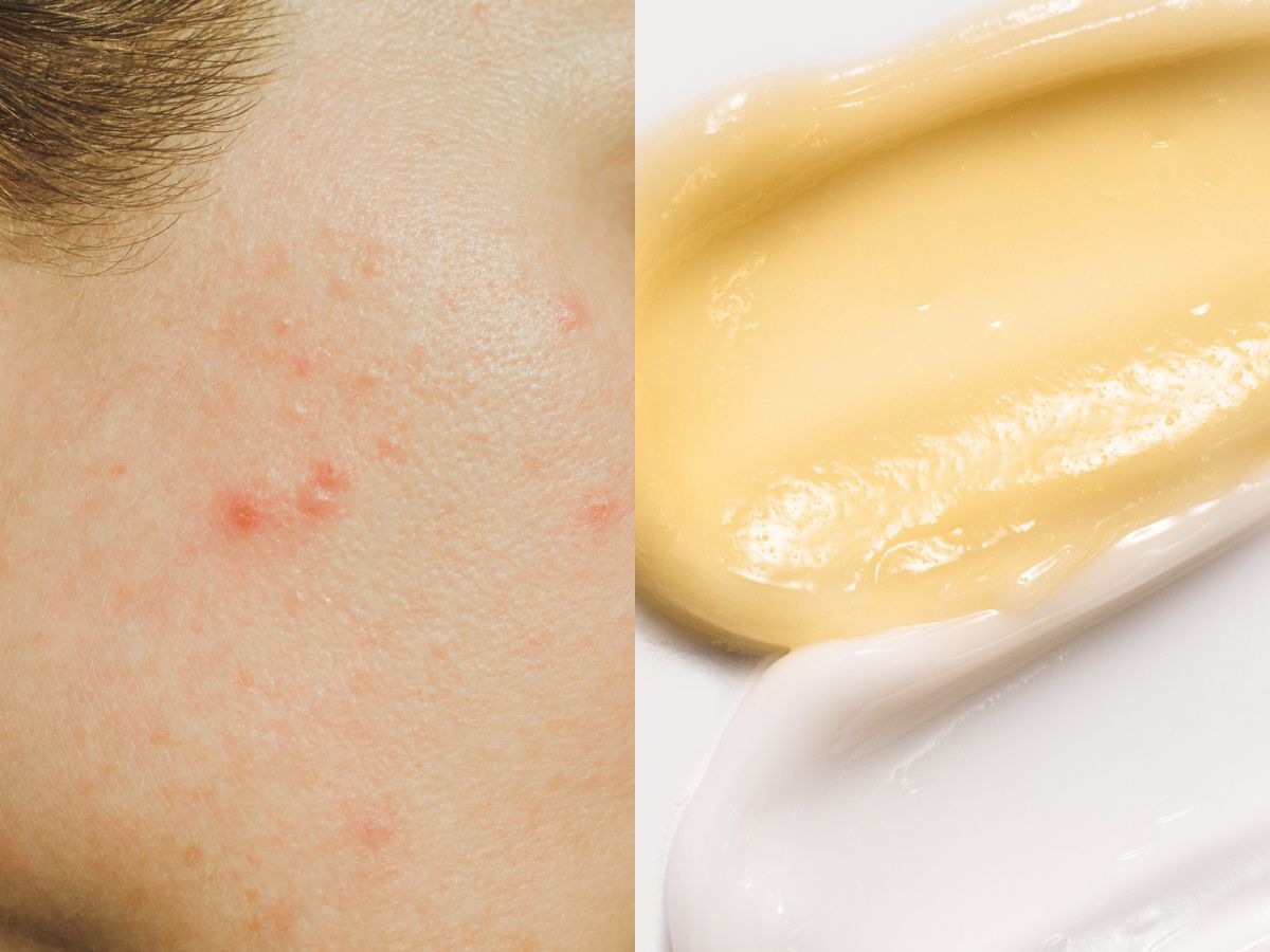 Anti Acne Dermo Cream