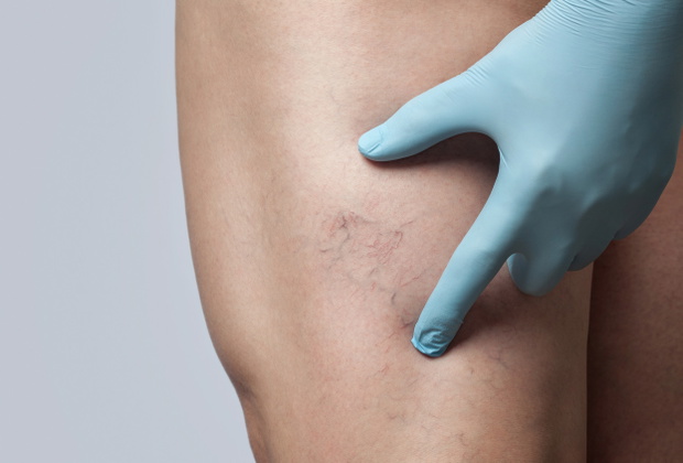 doctor shows  the dilation of small blood vessels of the skin on the leg. Medical inspection and treatment of Telangiectasia.