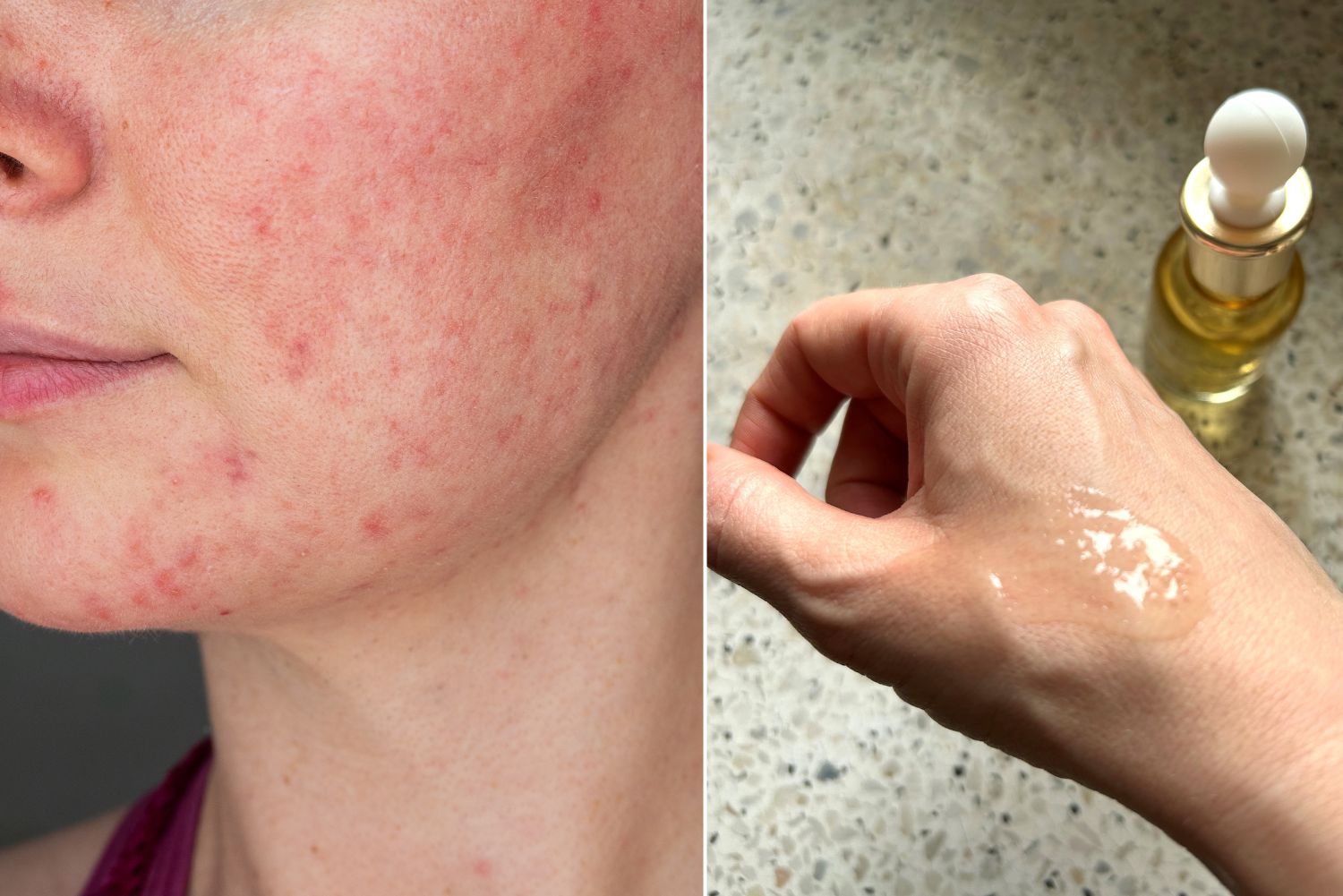 serum z propolisem