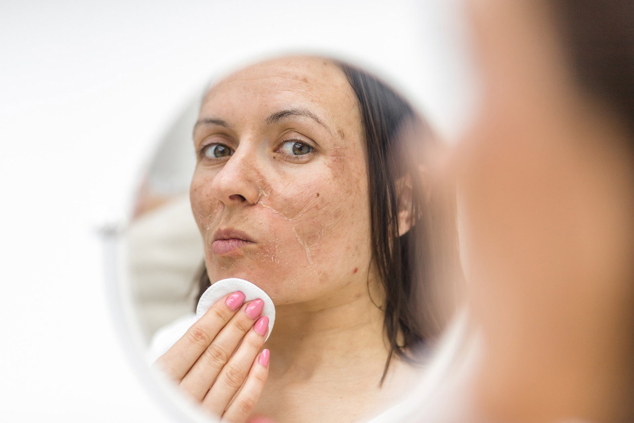 melasma