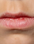 Suche usta przed zastosowaniem serum z PHA